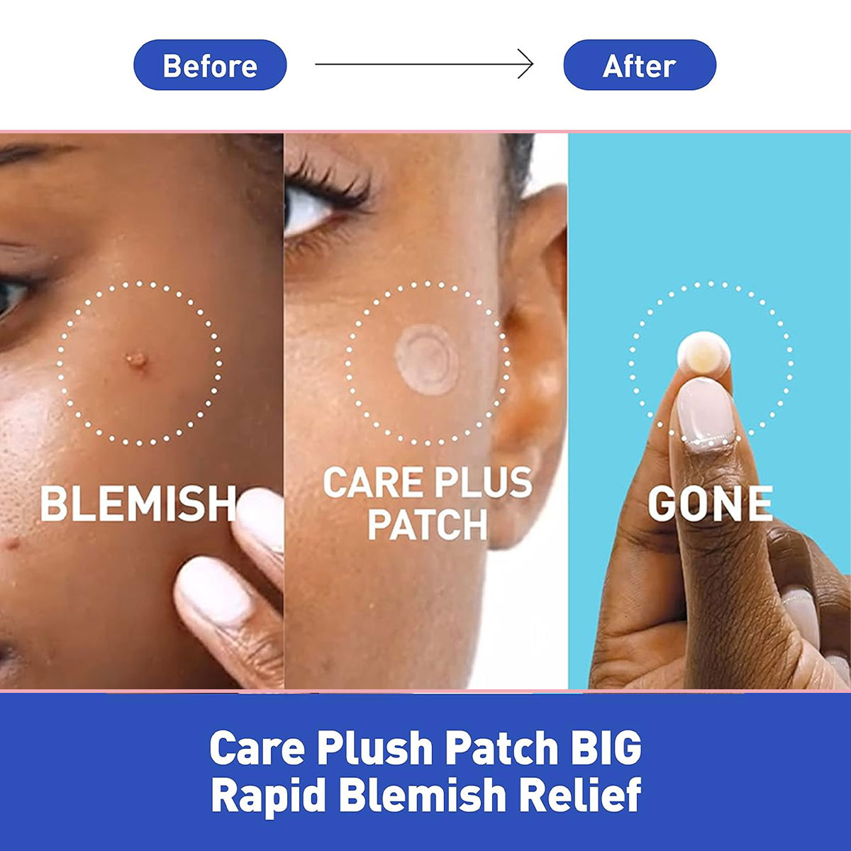 Parches para Cubrir Manchas Ol - Skincare Acne reseña y precio
